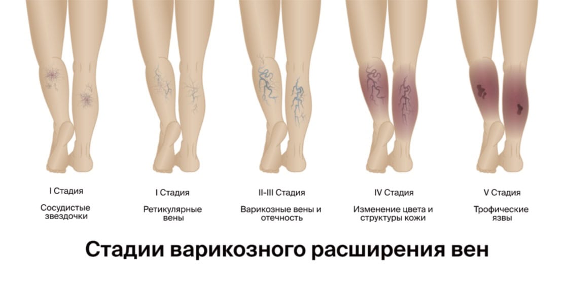 Симптоми і стадії варикозу